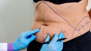 Exploring Non-Surgical Alternatives to Tummy Tucks: What’s New in Body Contouring?